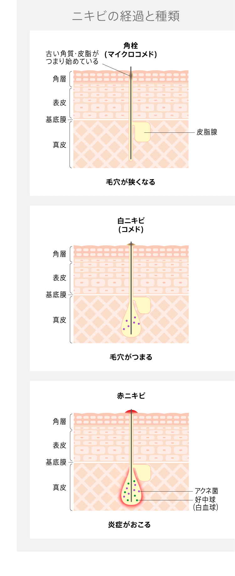 ニキビの経過と種類