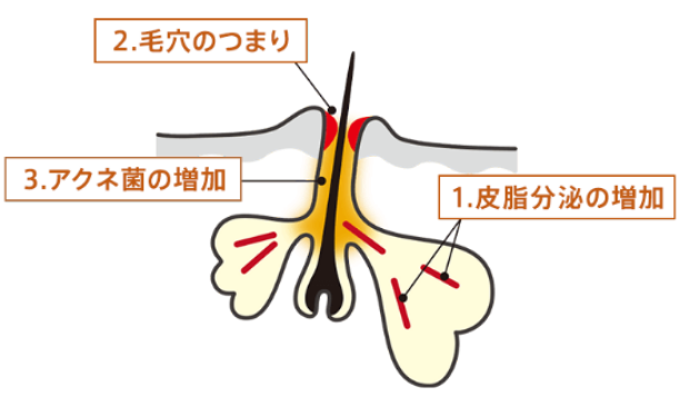 ニキビができる原因